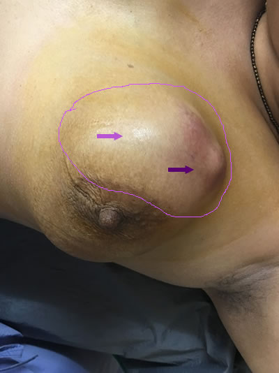 A large breast lump with nipple deviation