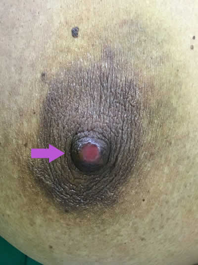 Nipple excoriatipn called as Paget's disease