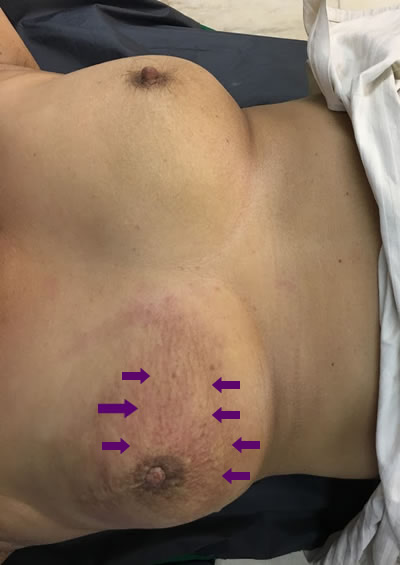 Thickening of skin due to involvement