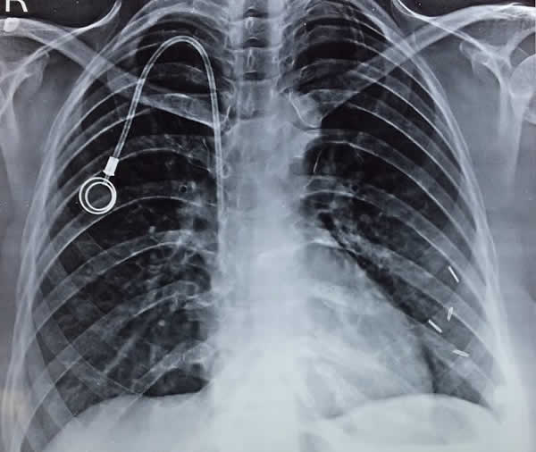 X ray showing chemoport