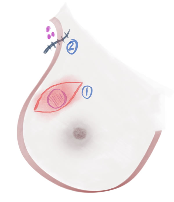 Breast Conserving Surgery depiction.