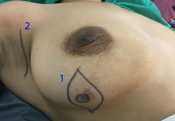 Breast Conserving Surgery marking during surgery.