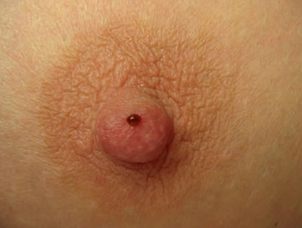 Bloody nipple discharge